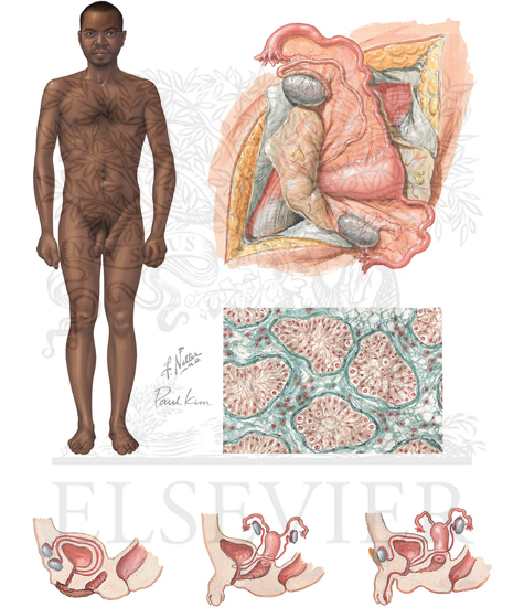 Watermarked preview of unlabeled image: Disorders of Sex Development (Continued)
