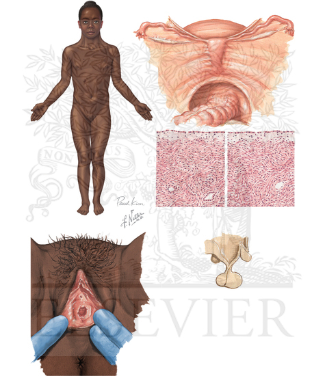 Watermarked preview of unlabeled image: Turner's Syndrome (Gonadal Dysgenesis)