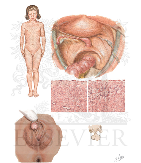 Turner's Syndrome (Gonadal Dysgenesis)(Continued)