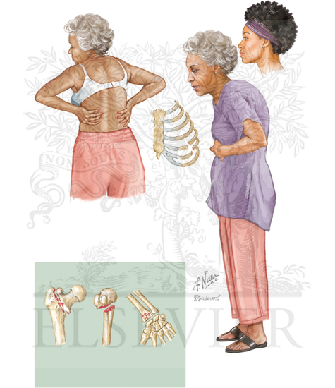 Osteoporosis in Postmenopausal Women