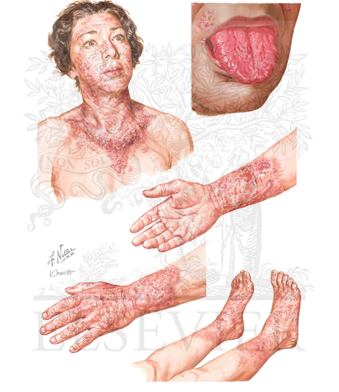Vitamin B3 Deficiency: Pellagra 