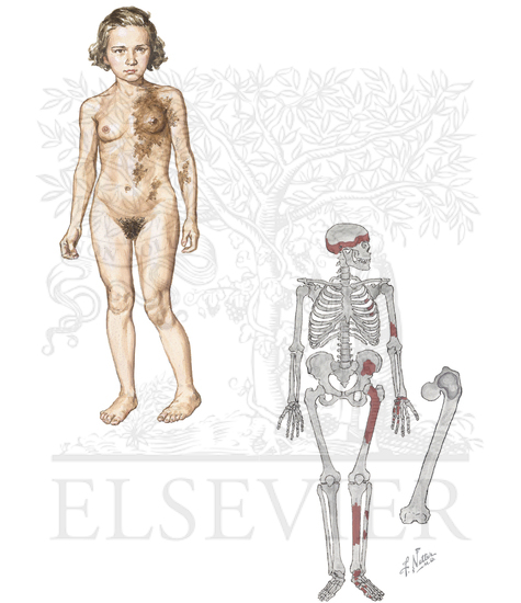 McCune-Albright Syndrome
