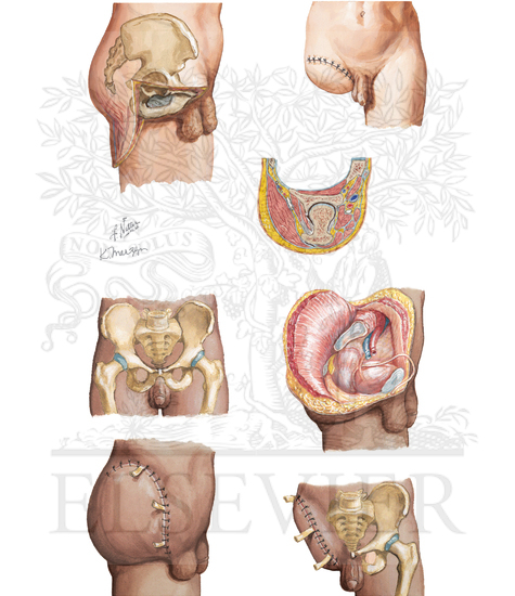 Watermarked preview of unlabeled image: Amputation of Lower Limb and Hip