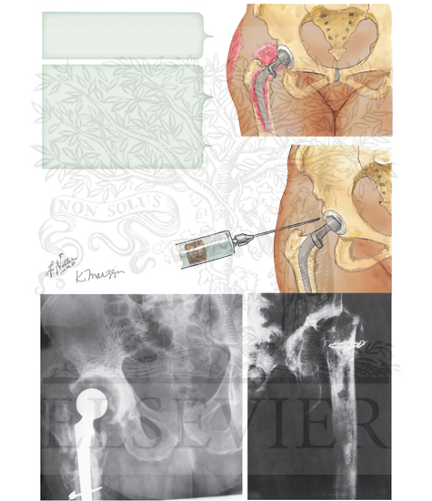 Total Hip Replacement: Infection