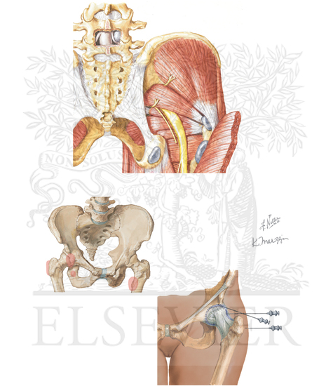 Trochanteric Bursitis