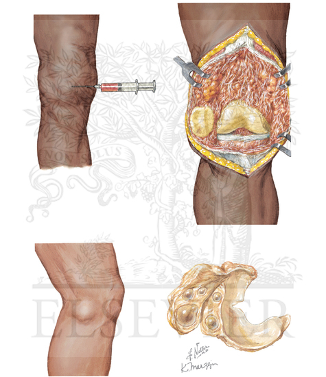 Watermarked preview of unlabeled image: Pigmented Villonodular Synovitis and Meniscal Cysts