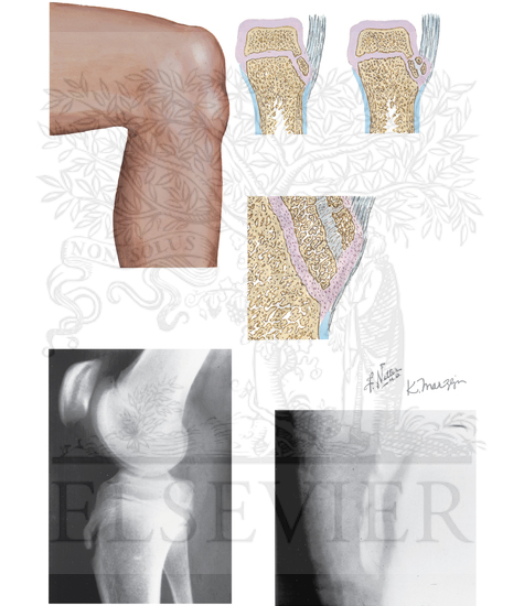 Watermarked preview of unlabeled image: Osgood-Schlatter Lesion
