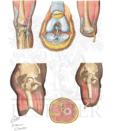 Disarticulation of Knee and Above-Knee Amputation