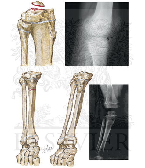 Watermarked preview of unlabeled image: Fracture of Tibia in Children