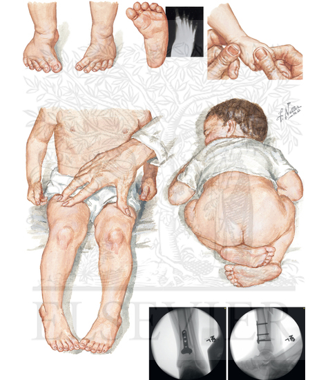 Watermarked preview of unlabeled image: Toeing In: Metatarsus Adductus and Internal Tibial Torsion