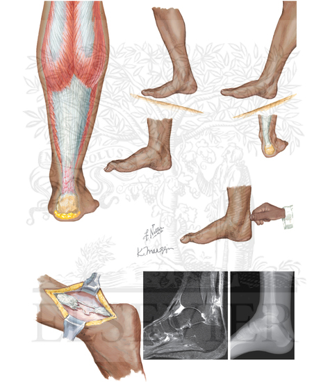 Achilles Tendon Rupture