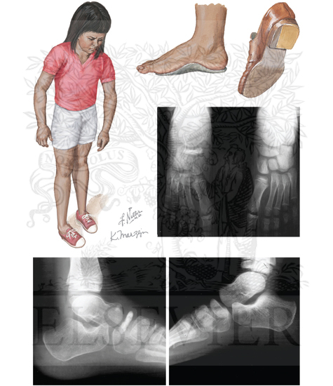 Watermarked preview of unlabeled image: Kohler Disease