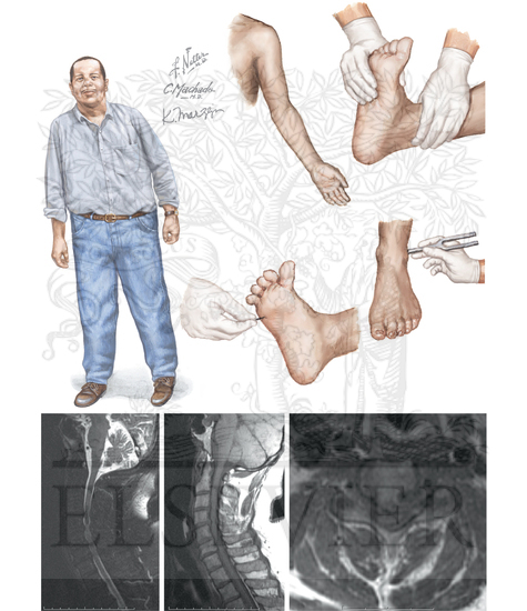 Cervical Spondylosis