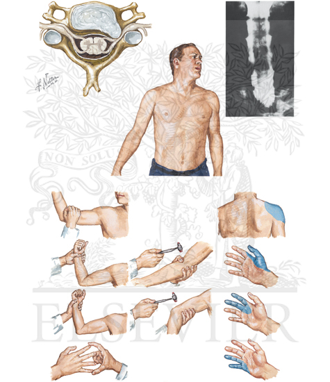 Watermarked preview of unlabeled image: Cervical Disc Herniation: Clinical Manifestations