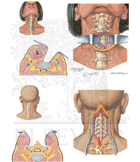 Watermarked preview of unlabeled image: Surgical Approaches for the Treatment of Myelopathy and Radiculopathy