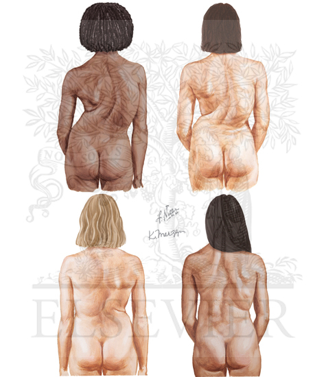 Typical Scoliosis Curve Patterns