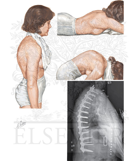 Watermarked preview of unlabeled image: Scheuermann Disease