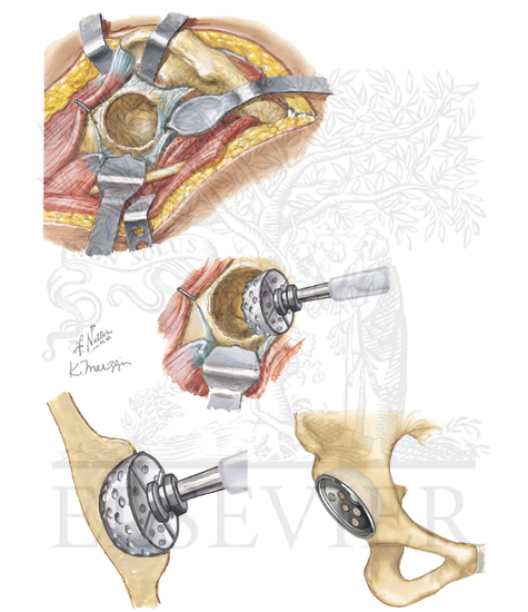 Watermarked preview of unlabeled image: Total Hip Replacement: Steps 9 to 12