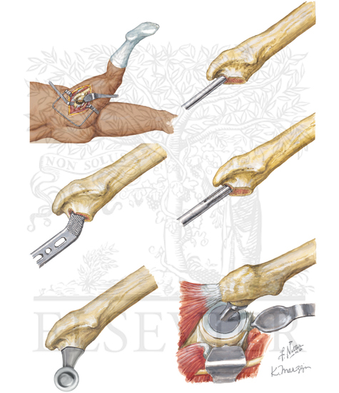 Watermarked preview of unlabeled image: Total Hip Replacement: Steps 13 to 18