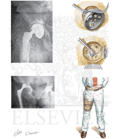 Total Hip Replacement: Complications-Loosening of Acetabular Component and Dislocation of Total Hip Prosthesis