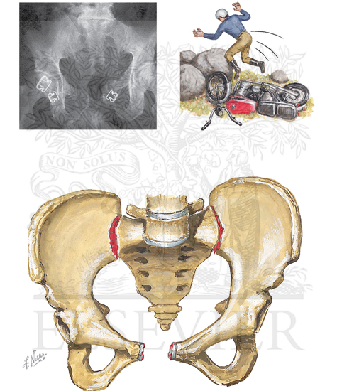 Injury to Pelvis: Open Book Fracture