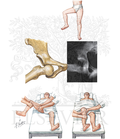 Injury to Hip: Anterior Dislocation of Hip, Obturator Type