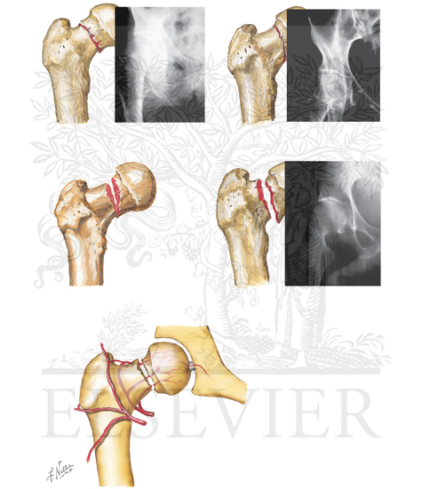 Intracapsular Fracture of Femoral Neck