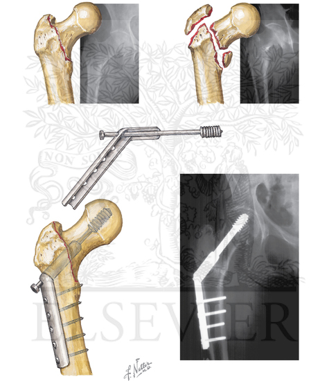 Intertrochanteric Fracture of Femur