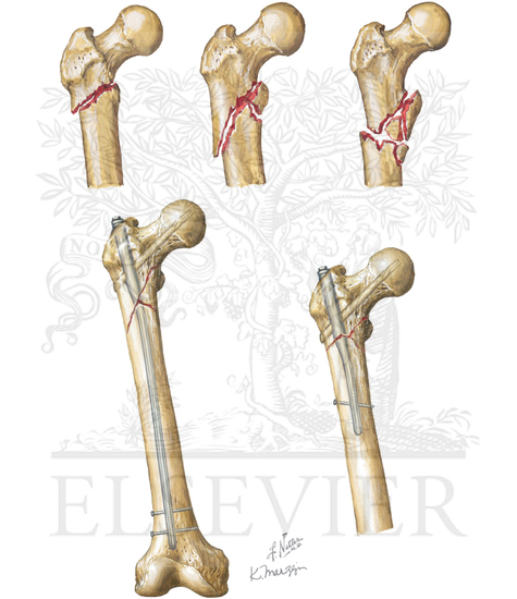 Subtrochanteric Fracture of Femur