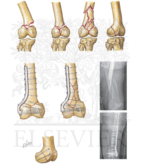 Fracture of Distal Femur