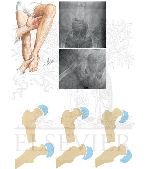 Physical Examination and Classification of Slipped Capital Femoral Epiphysis