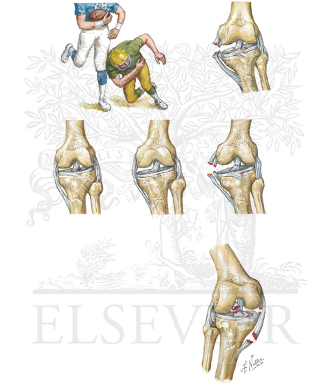 Sprains of Knee Ligaments