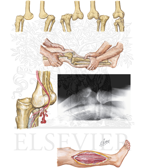 Dislocation of Knee Joint