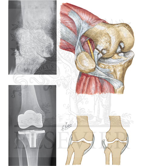 Lateral Release for Valgus Deformity of Knee