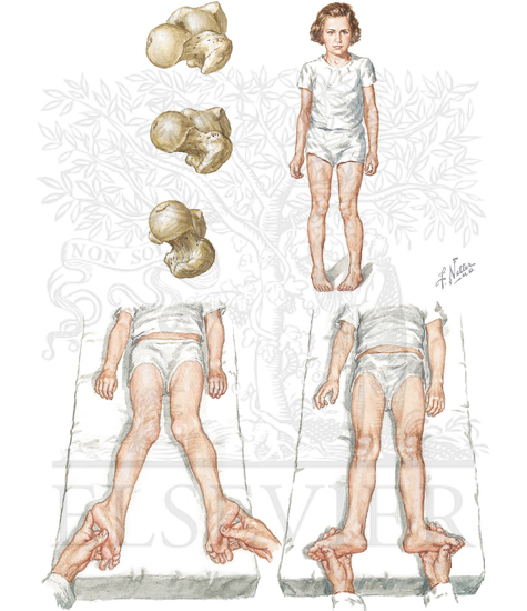 Toeing In: Internal Femoral Torsion