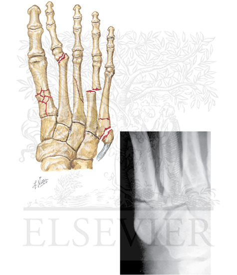 Fifth Metatarsal Fractures