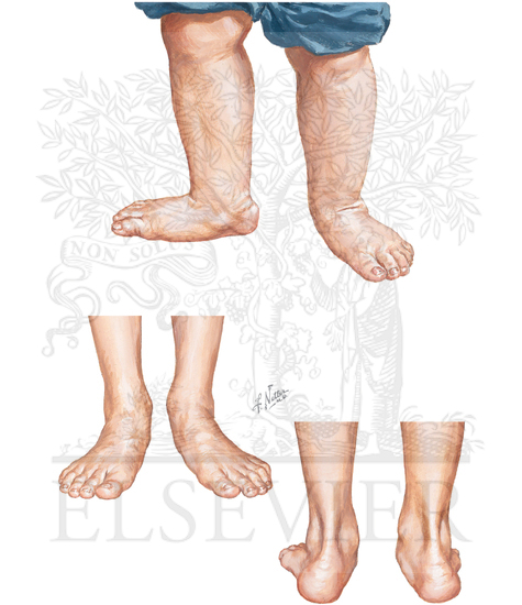 Calcaneovalgus and Planovalgus