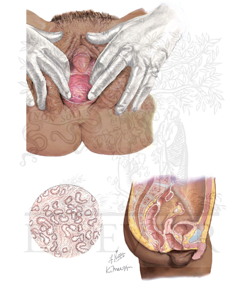 Intersex: Male Gonadal