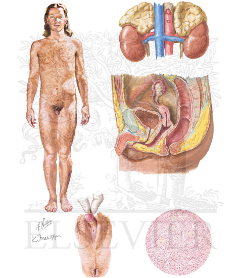 Intersex: Female