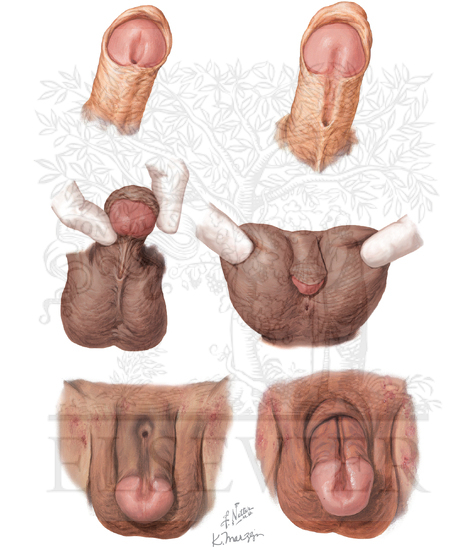 Hypospadias and Epispadias