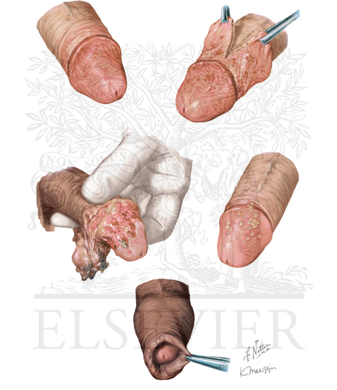 Balanitis