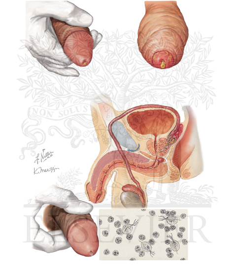 Urethritis