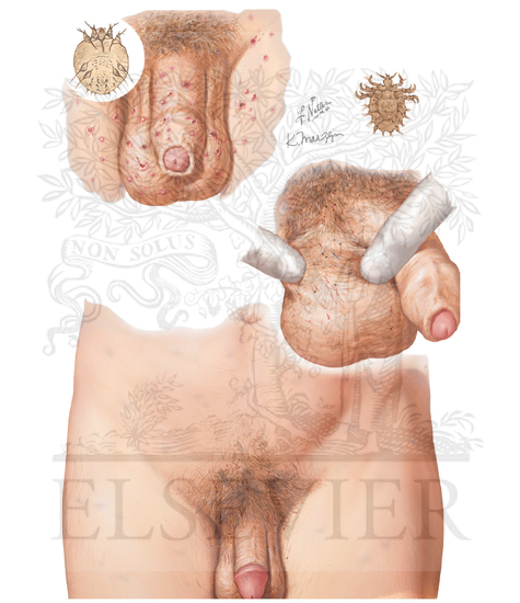 Scrotal Skin Diseases: Scabies and Lice