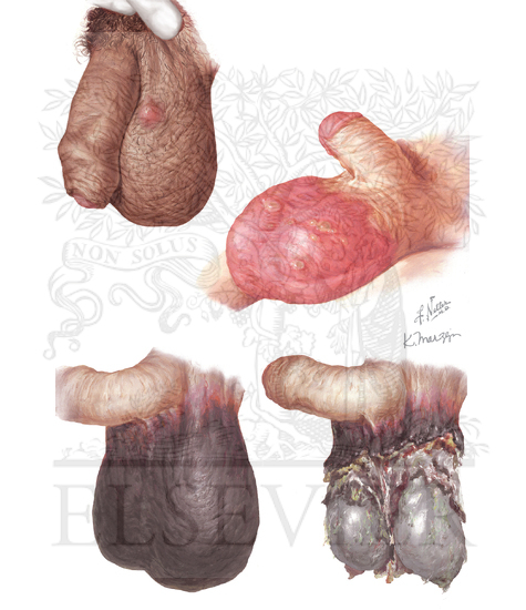 Infection, Gangrene