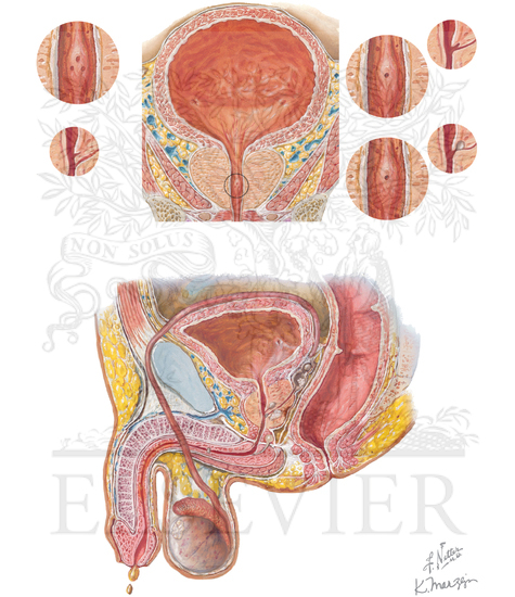 Watermarked preview of unlabeled image: Congenital variations in ejaculatory duct anatomy