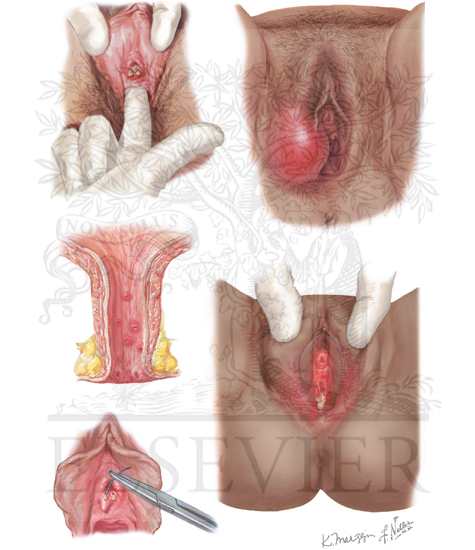 Gonorrhea