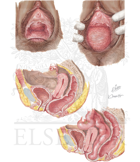 Watermarked preview of unlabeled image: Rectocele, Enterocele