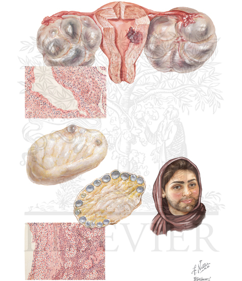 Endocrinopathies: Luteinization