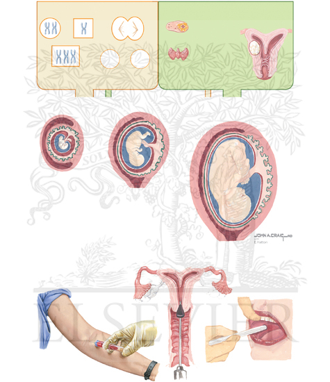 Recurrent Abortion
