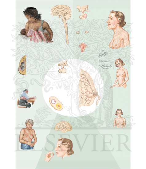 Galactorrhea